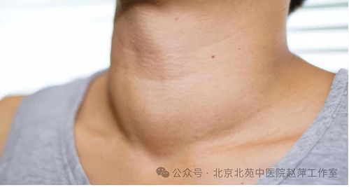 甲状腺结节怎样有效消除赵萍专家想要结节好,趁早做好这3点