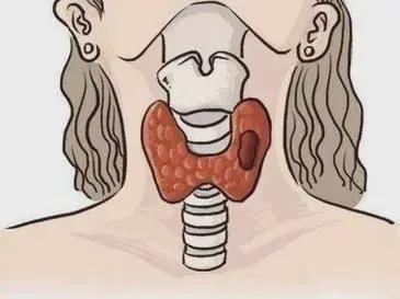 及时发现甲状腺结节