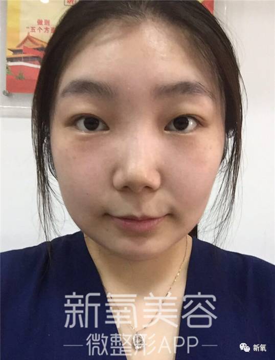 袁姗姗脸肿成甩饼就算了,这鼻子也平了莫非是被肉挤得